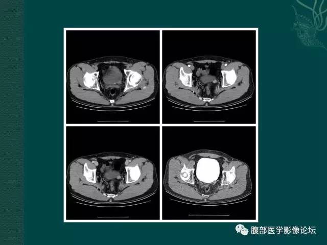 【病例】左输尿管下段区副神经节瘤1例CT影像表现