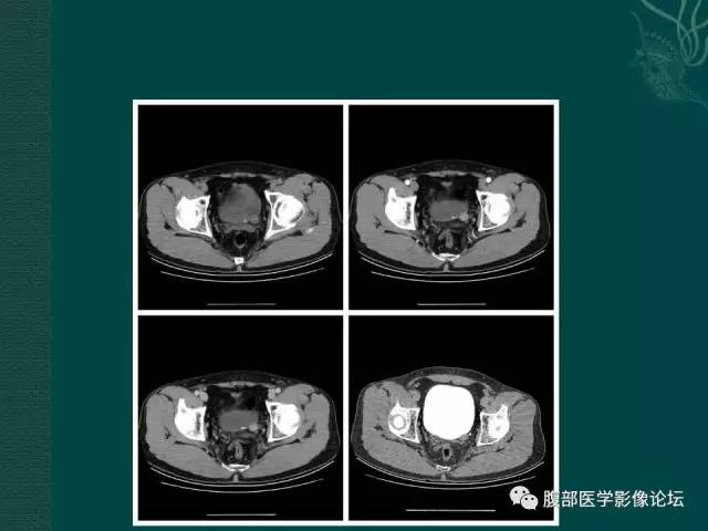 【病例】左输尿管下段区副神经节瘤1例CT影像表现