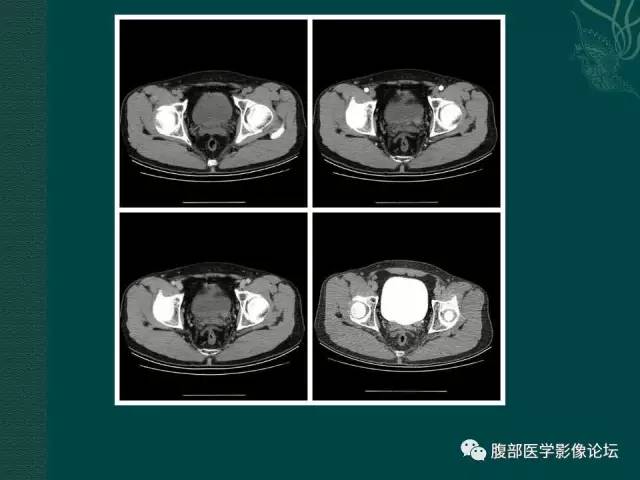 【病例】左输尿管下段区副神经节瘤1例CT影像表现