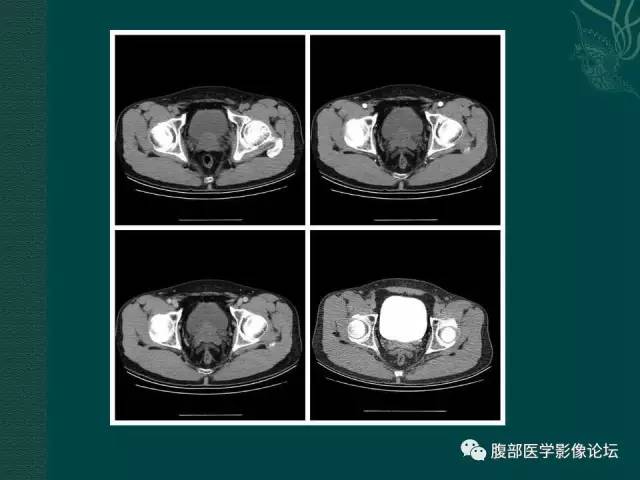 【病例】左输尿管下段区副神经节瘤1例CT影像表现