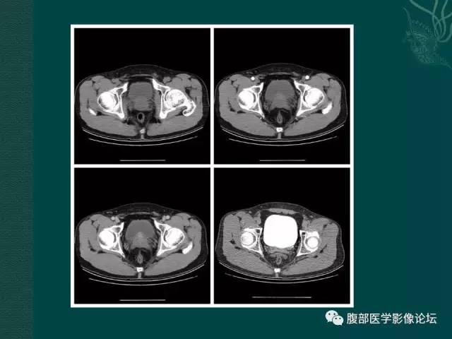【病例】左输尿管下段区副神经节瘤1例CT影像表现