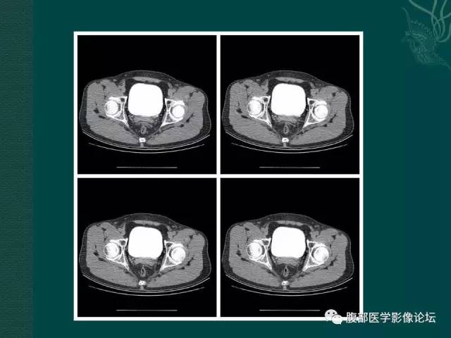 【病例】左输尿管下段区副神经节瘤1例CT影像表现