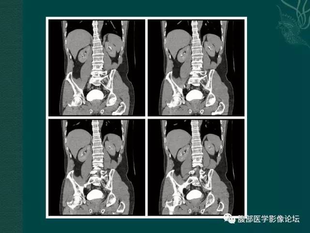 【病例】左输尿管下段区副神经节瘤1例CT影像表现