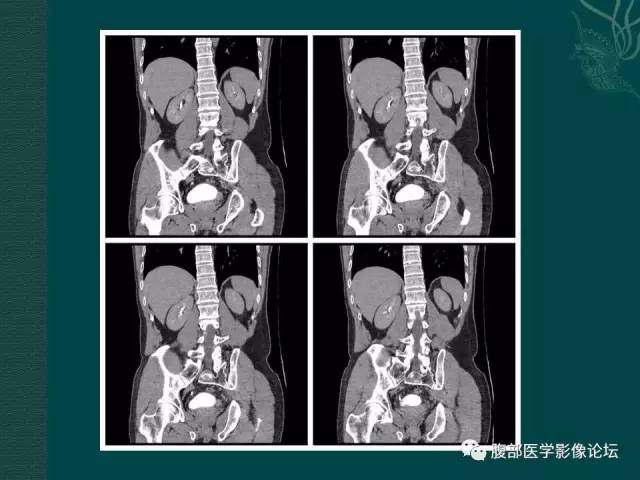 【病例】左输尿管下段区副神经节瘤1例CT影像表现