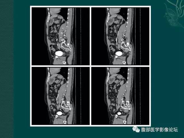 【病例】左输尿管下段区副神经节瘤1例CT影像表现