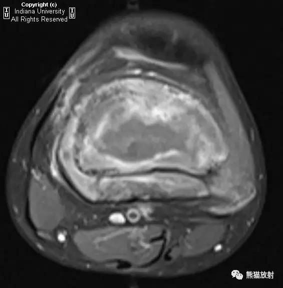 【双语病例】骨肉瘤1例X线/MRI影像表现 【双语病例】骨肉瘤1例X线/MRI影像表现