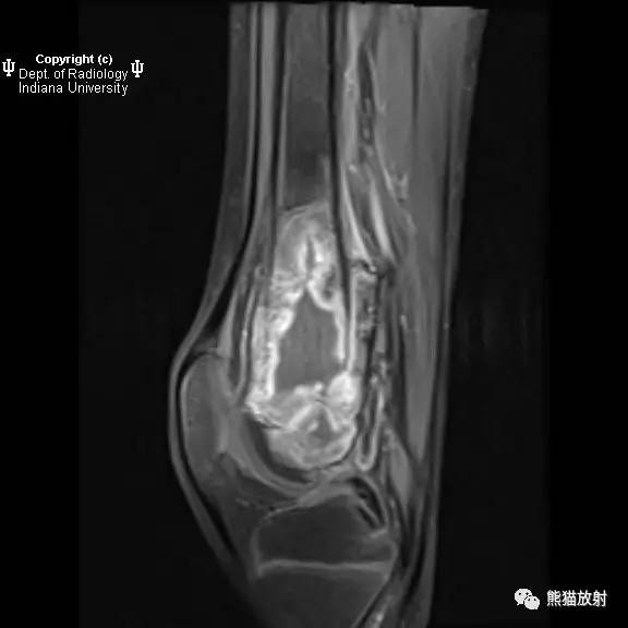 【双语病例】骨肉瘤1例X线/MRI影像表现 【双语病例】骨肉瘤1例X线/MRI影像表现