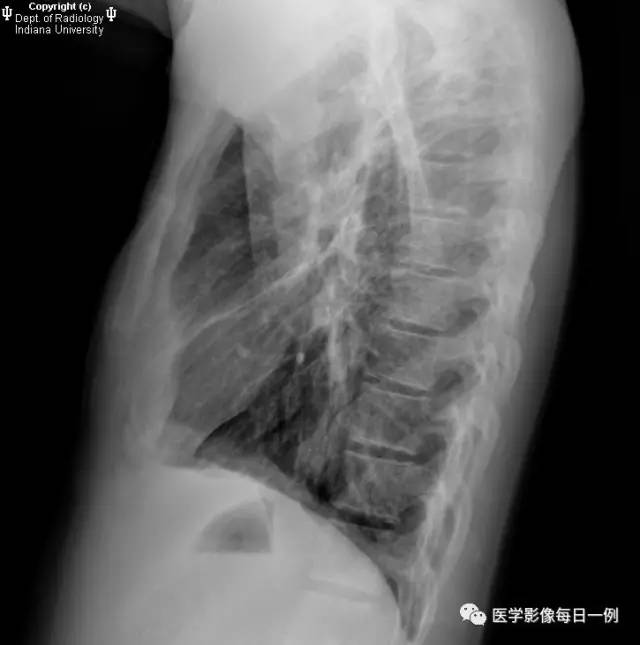 【病例】左下肺肺隔离症合并感染1例CT 【病例】左下肺肺隔离症合并感染1例CT