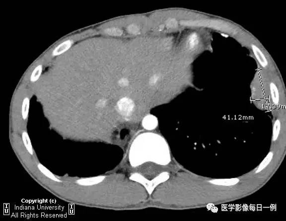 【病例】左下肺肺隔离症合并感染1例CT 【病例】左下肺肺隔离症合并感染1例CT
