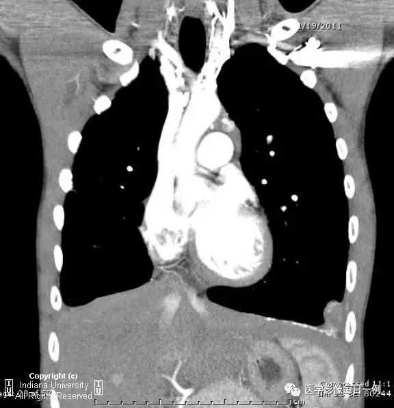【病例】左下肺肺隔离症合并感染1例CT 【病例】左下肺肺隔离症合并感染1例CT