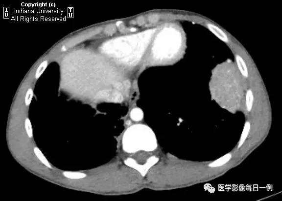 【病例】左下肺肺隔离症合并感染1例CT 【病例】左下肺肺隔离症合并感染1例CT
