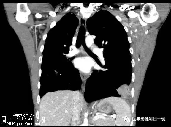 【病例】左下肺肺隔离症合并感染1例CT 【病例】左下肺肺隔离症合并感染1例CT