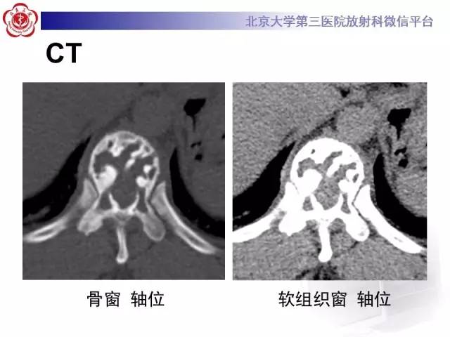 【病例】脊柱孤立性浆细胞瘤1例CT/MR影像表现