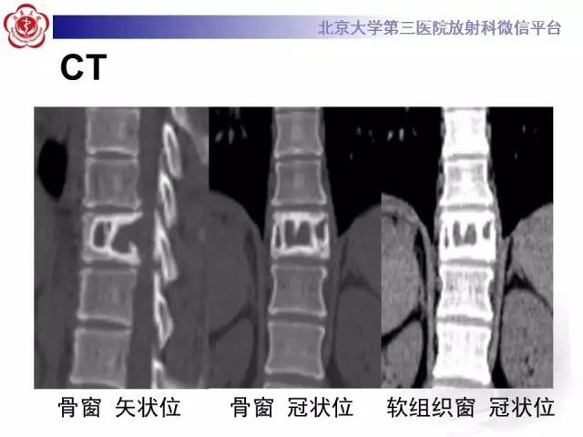 【病例】脊柱孤立性浆细胞瘤1例CT/MR影像表现