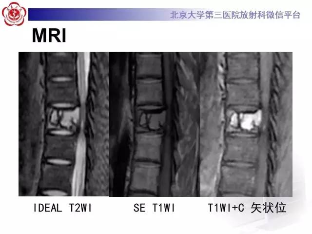 【病例】脊柱孤立性浆细胞瘤1例CT/MR影像表现