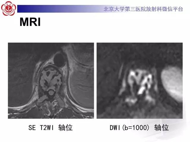 【病例】脊柱孤立性浆细胞瘤1例CT/MR影像表现
