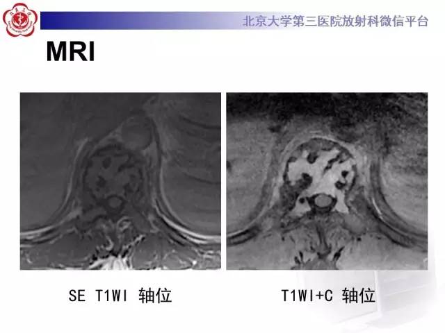 【病例】脊柱孤立性浆细胞瘤1例CT/MR影像表现