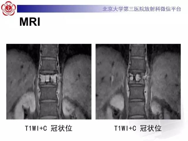 【病例】脊柱孤立性浆细胞瘤1例CT/MR影像表现