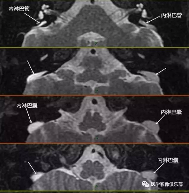 大前庭导水管综合征