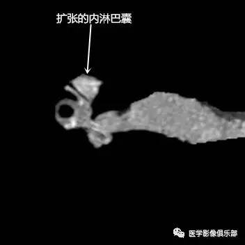 大前庭导水管综合征 大前庭导水管综合征
