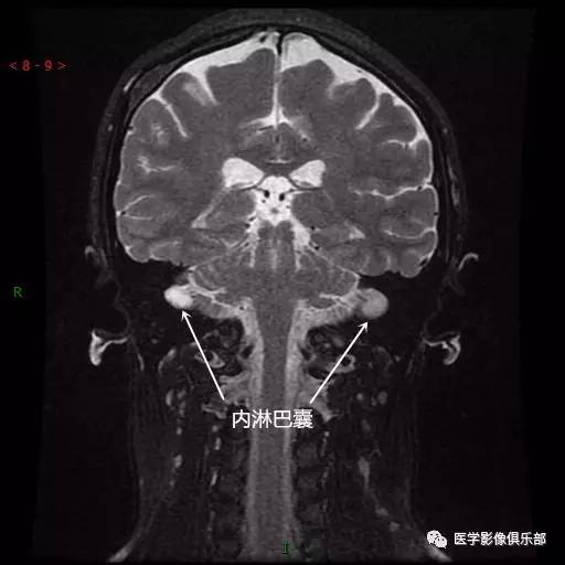 大前庭导水管综合征 大前庭导水管综合征