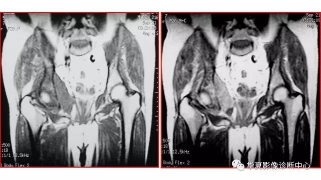 【病例】髋关节淋巴瘤1例X线CT及MR影像表现