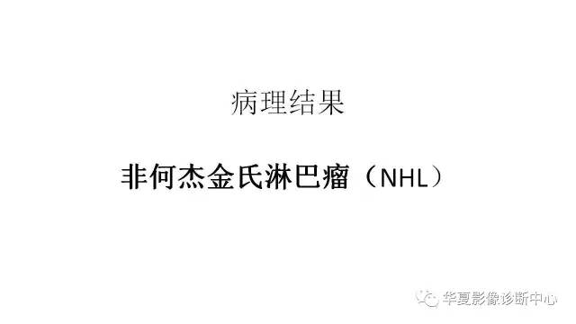 【病例】髋关节淋巴瘤1例X线CT及MR影像表现