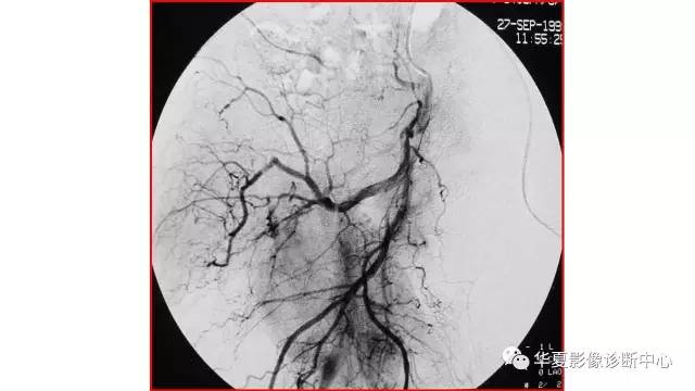 【病例】髋关节淋巴瘤1例X线CT及MR影像表现
