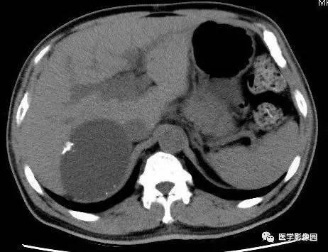 【病例】右侧肾上腺囊肿(假性囊肿)1例CT 【病例】右侧肾上腺囊肿(假性囊肿)1例CT