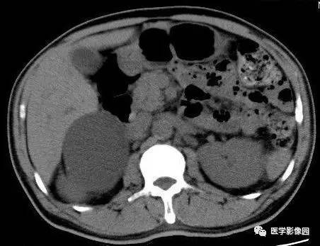 【病例】右侧肾上腺囊肿(假性囊肿)1例CT 【病例】右侧肾上腺囊肿(假性囊肿)1例CT