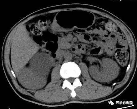 【病例】右侧肾上腺囊肿(假性囊肿)1例CT 【病例】右侧肾上腺囊肿(假性囊肿)1例CT