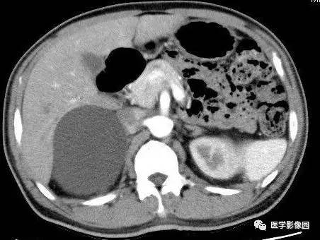 【病例】右侧肾上腺囊肿(假性囊肿)1例CT 【病例】右侧肾上腺囊肿(假性囊肿)1例CT