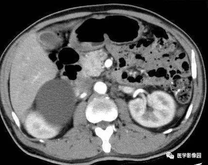 【病例】右侧肾上腺囊肿(假性囊肿)1例CT 【病例】右侧肾上腺囊肿(假性囊肿)1例CT