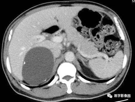 【病例】右侧肾上腺囊肿(假性囊肿)1例CT 【病例】右侧肾上腺囊肿(假性囊肿)1例CT