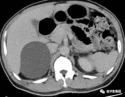 【病例】右侧肾上腺囊肿(假性囊肿)1例CT 【病例】右侧肾上腺囊肿(假性囊肿)1例CT