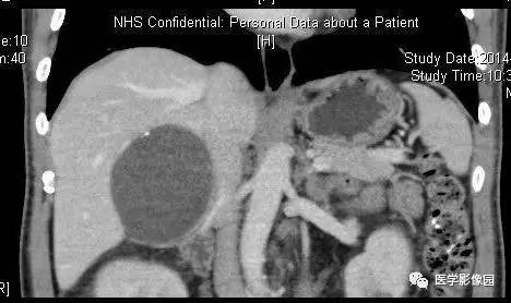 【病例】右侧肾上腺囊肿(假性囊肿)1例CT 【病例】右侧肾上腺囊肿(假性囊肿)1例CT