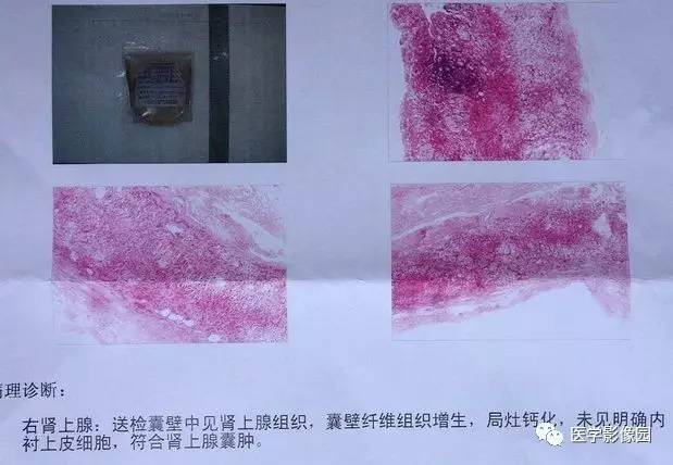 【病例】右侧肾上腺囊肿(假性囊肿)1例CT 【病例】右侧肾上腺囊肿(假性囊肿)1例CT