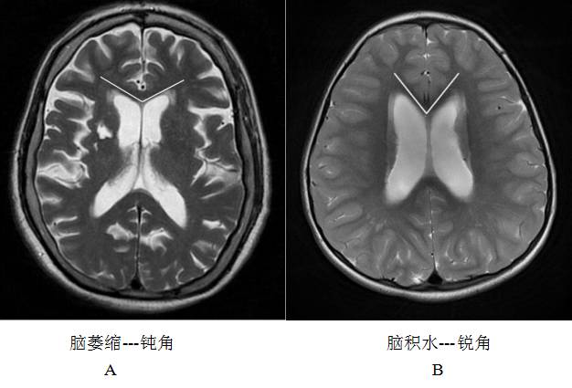 正常压力性脑积水
