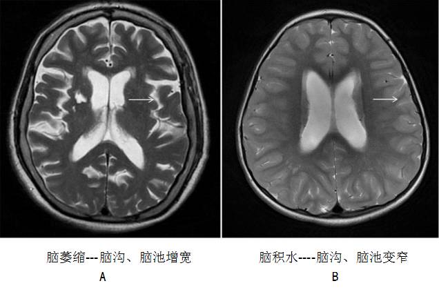 正常压力性脑积水 正常压力性脑积水