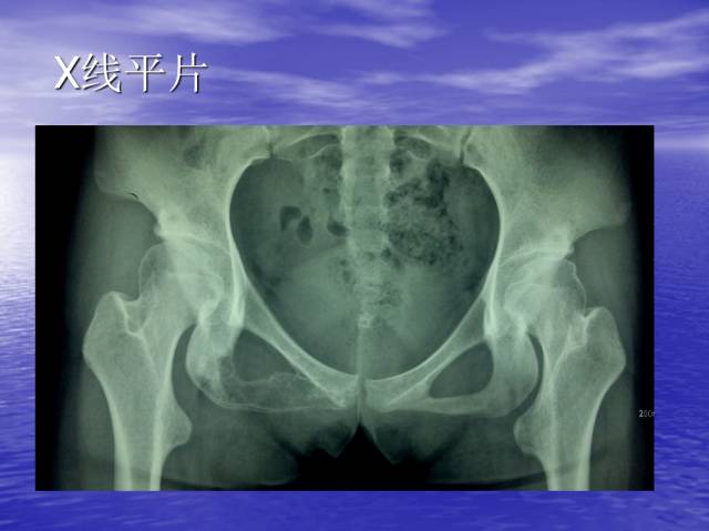【病例】右侧坐骨血管肉瘤1例X线CT及MR
