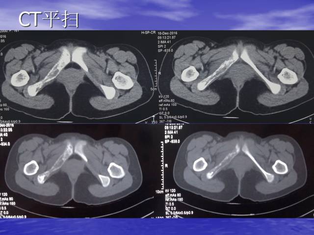 【病例】右侧坐骨血管肉瘤1例X线CT及MR
