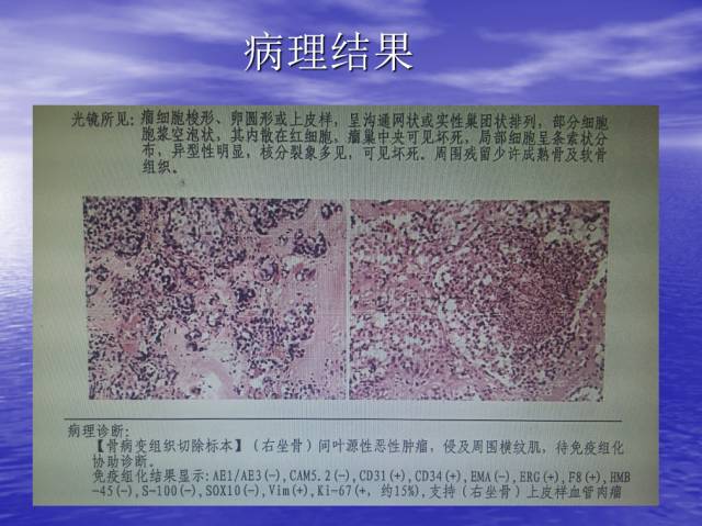 【病例】右侧坐骨血管肉瘤1例X线CT及MR