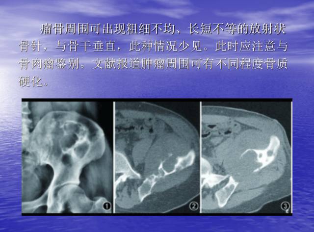 【病例】右侧坐骨血管肉瘤1例X线CT及MR