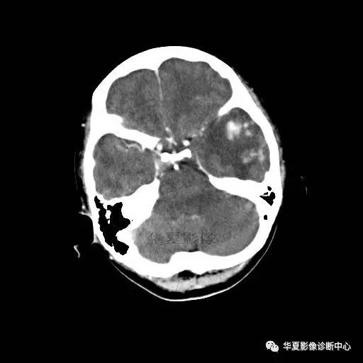 血吸虫脑病的影像诊断