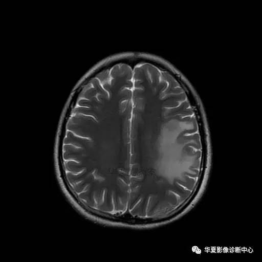 血吸虫脑病的影像诊断 血吸虫脑病的影像诊断