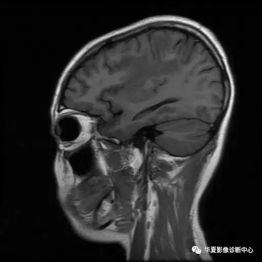 血吸虫脑病的影像诊断 血吸虫脑病的影像诊断