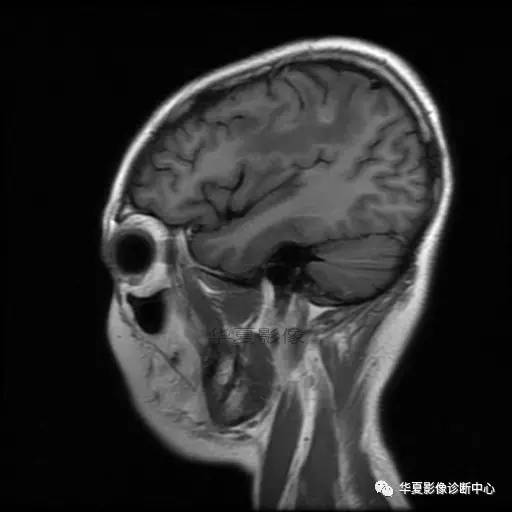血吸虫脑病的影像诊断 血吸虫脑病的影像诊断