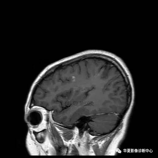 血吸虫脑病的影像诊断 血吸虫脑病的影像诊断