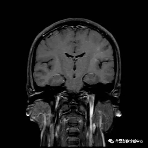 血吸虫脑病的影像诊断 血吸虫脑病的影像诊断