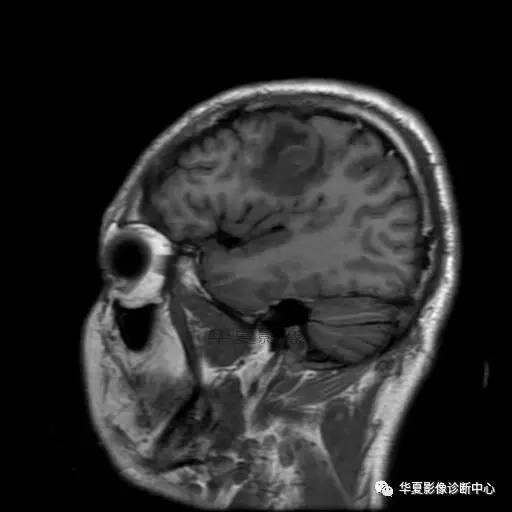 血吸虫脑病的影像诊断 血吸虫脑病的影像诊断